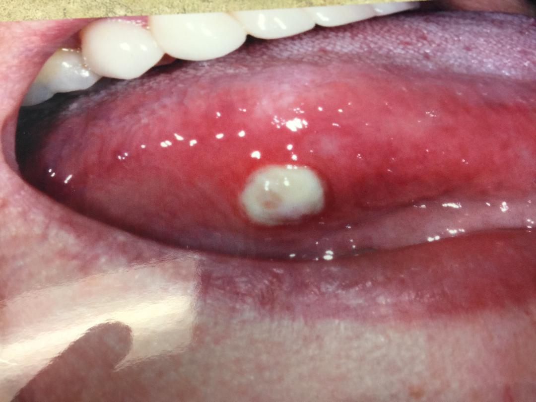 Oral Cancer Sores On Tongue