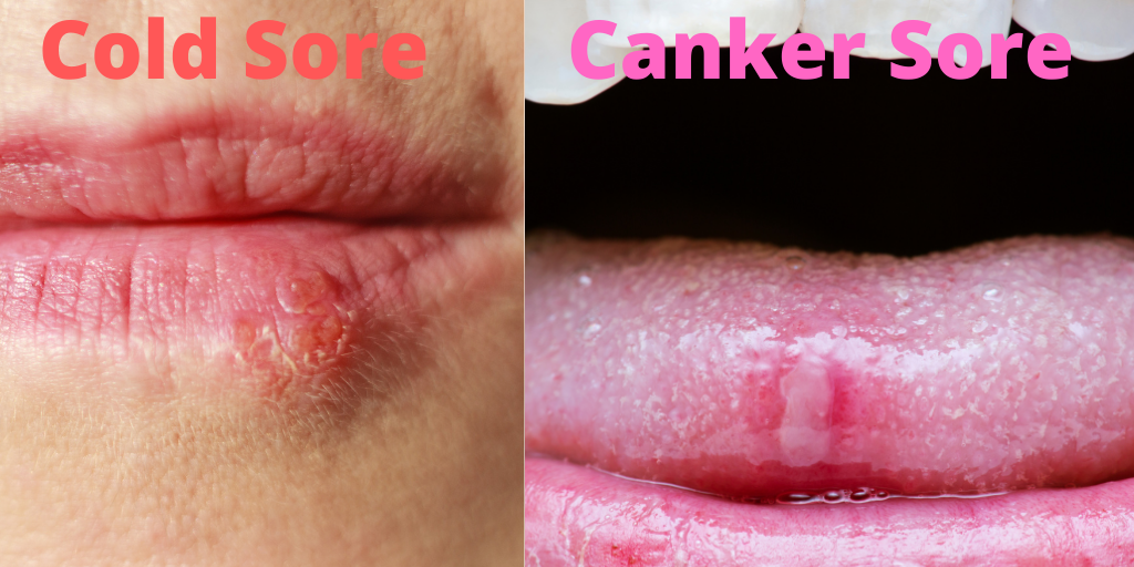 Are Canker Sores Contagious